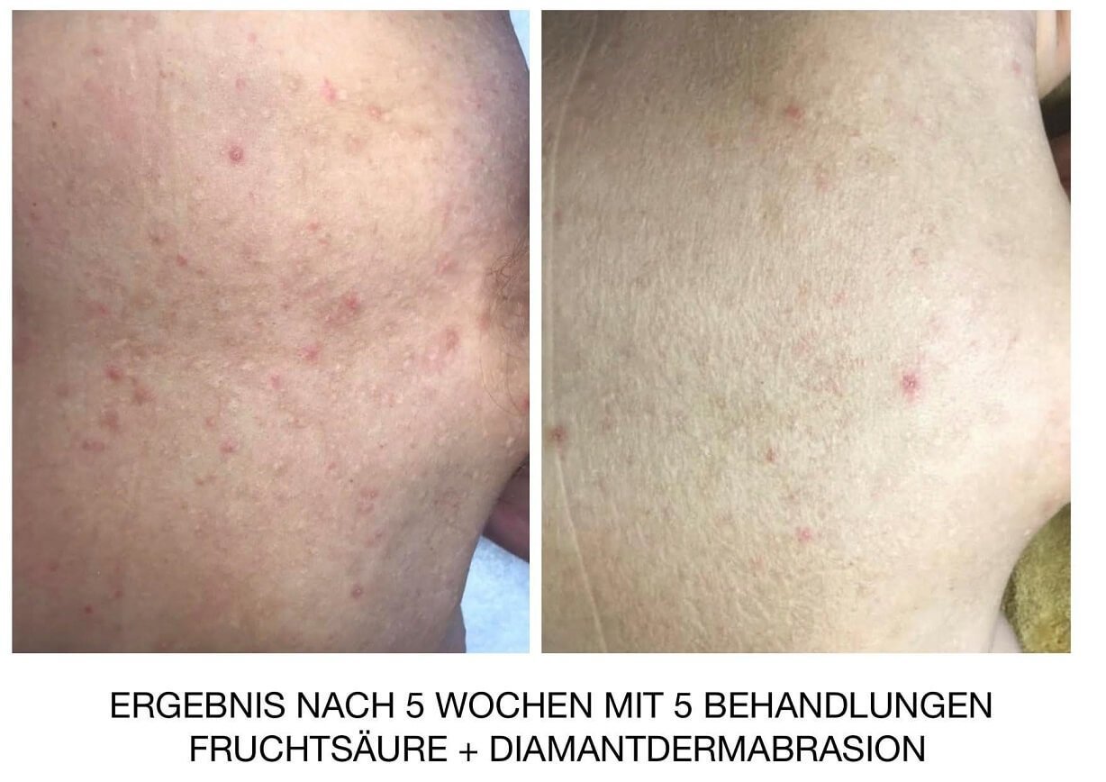 Fruchtsäurepeeling Wiesbaden