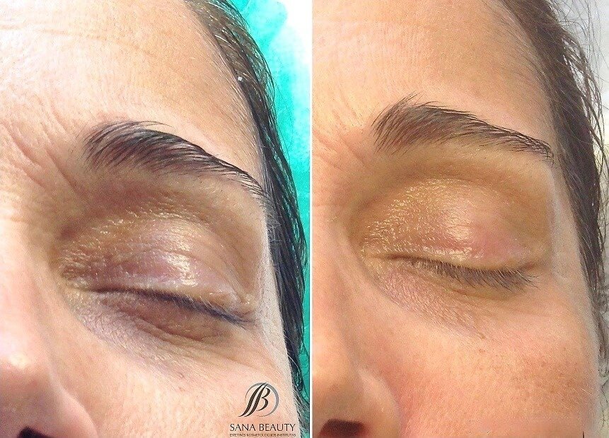 Sana Beauty in Wiesbaden – Radiofrequenz für Ihre Schönheit