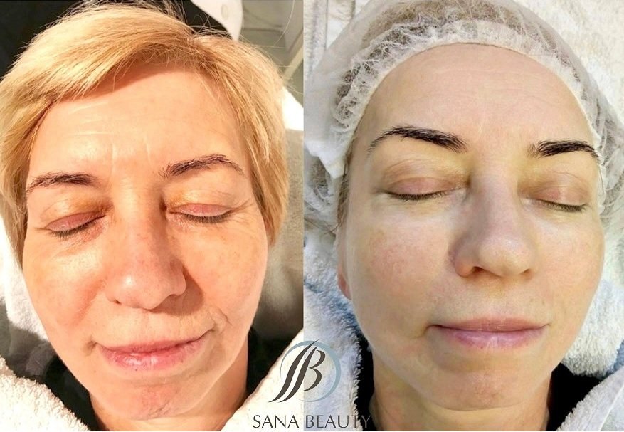 Radiofrequenz Gesicht bei Sana Beauty Wiesbaden